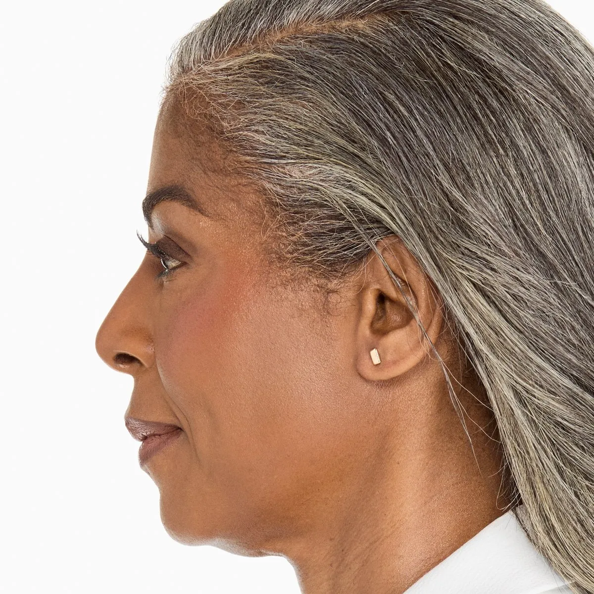Before Ultherapy · Chin and neck