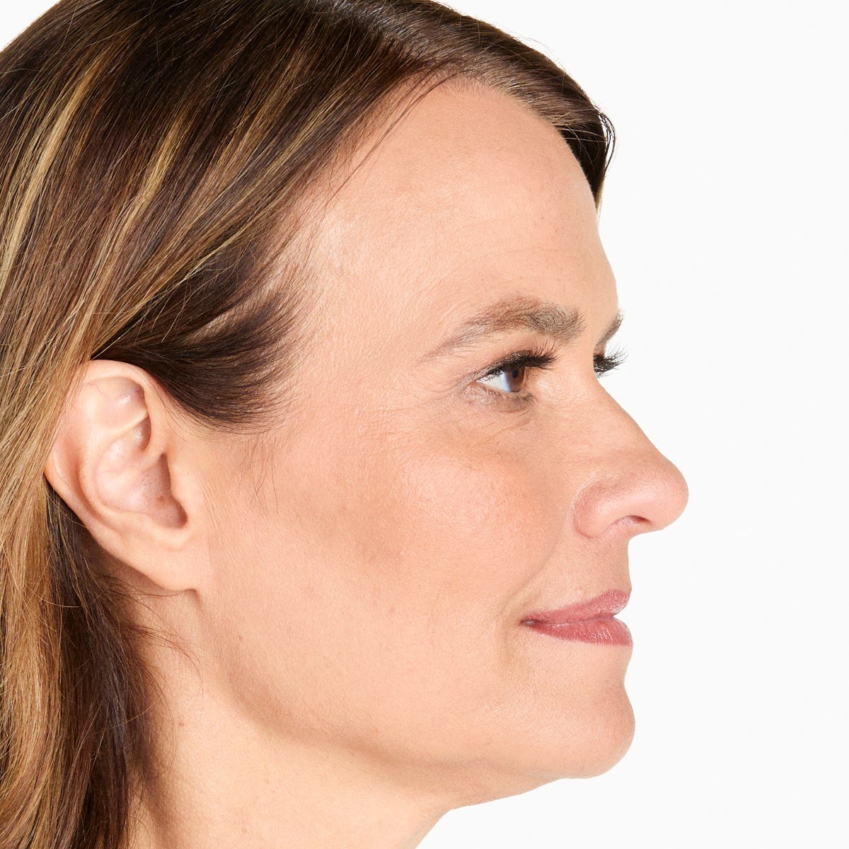After Ultherapy · Jawline, profile