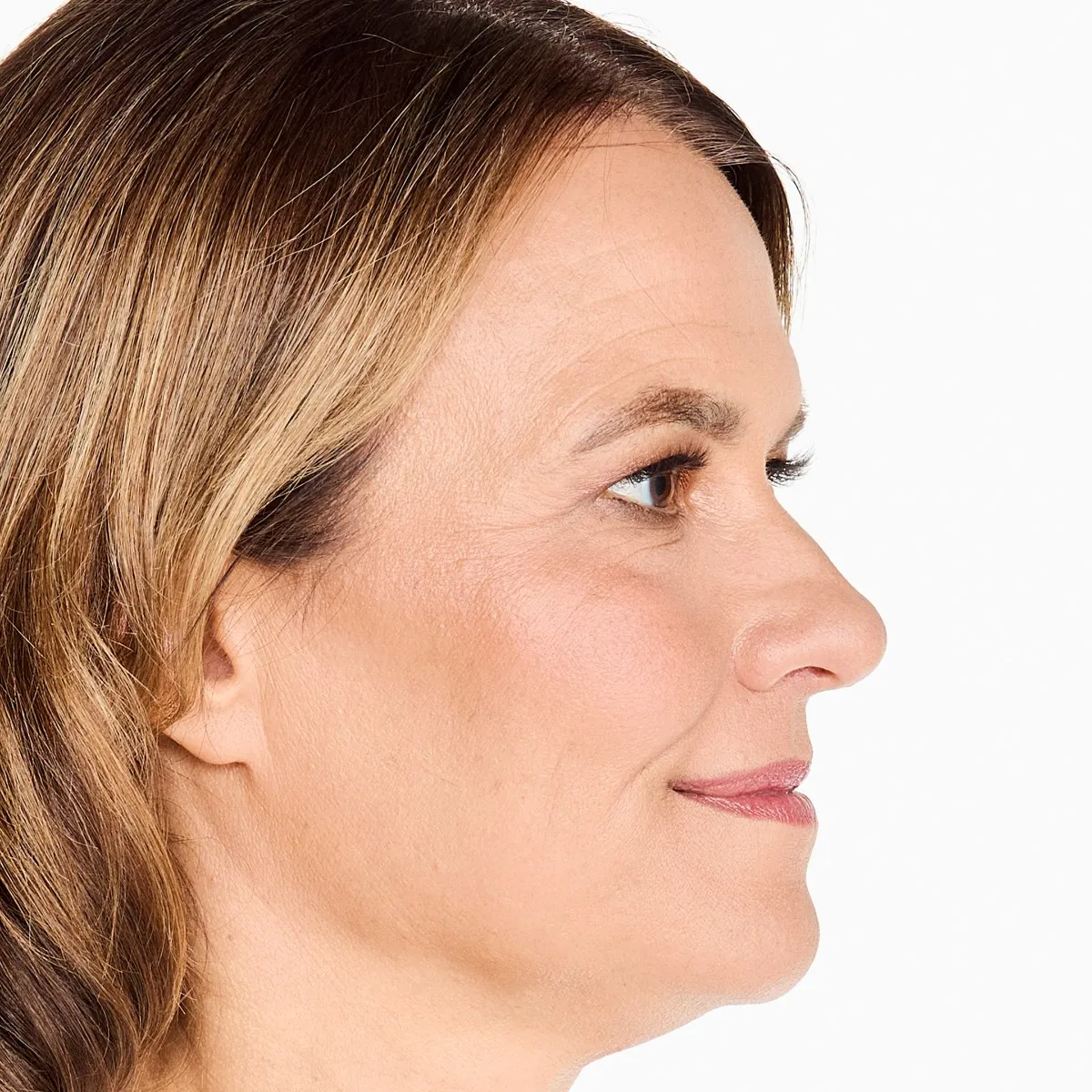 Before Ultherapy · Jawline, profile