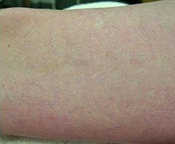 After Veins