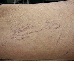 Before Veins
