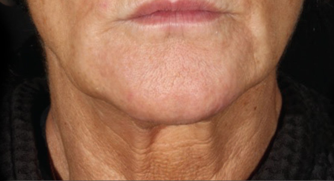 After XERF · Lower face and neck