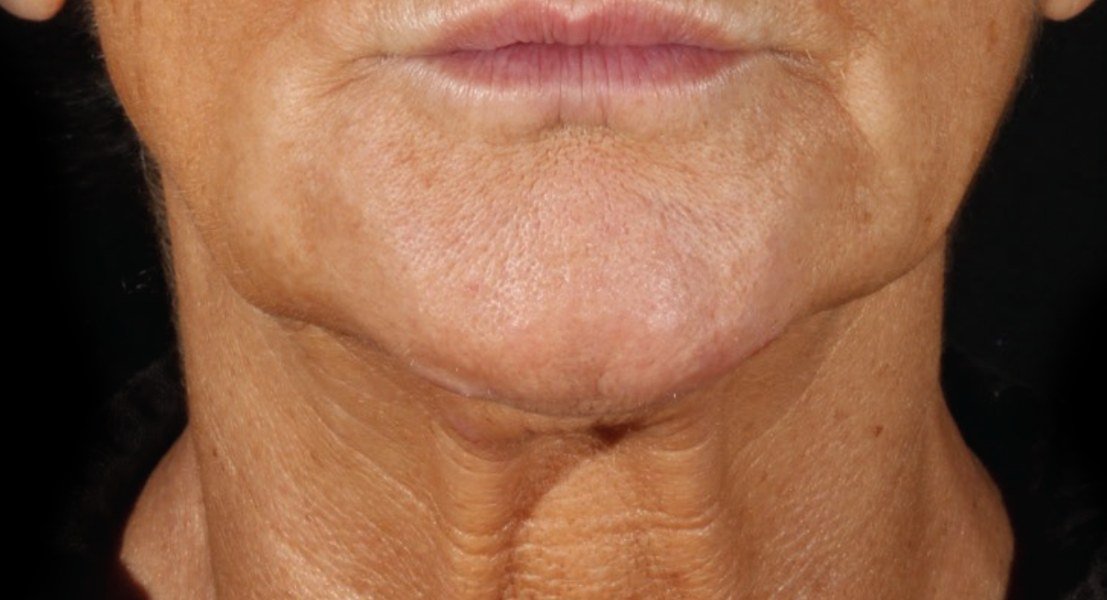 Before XERF · Lower face and neck