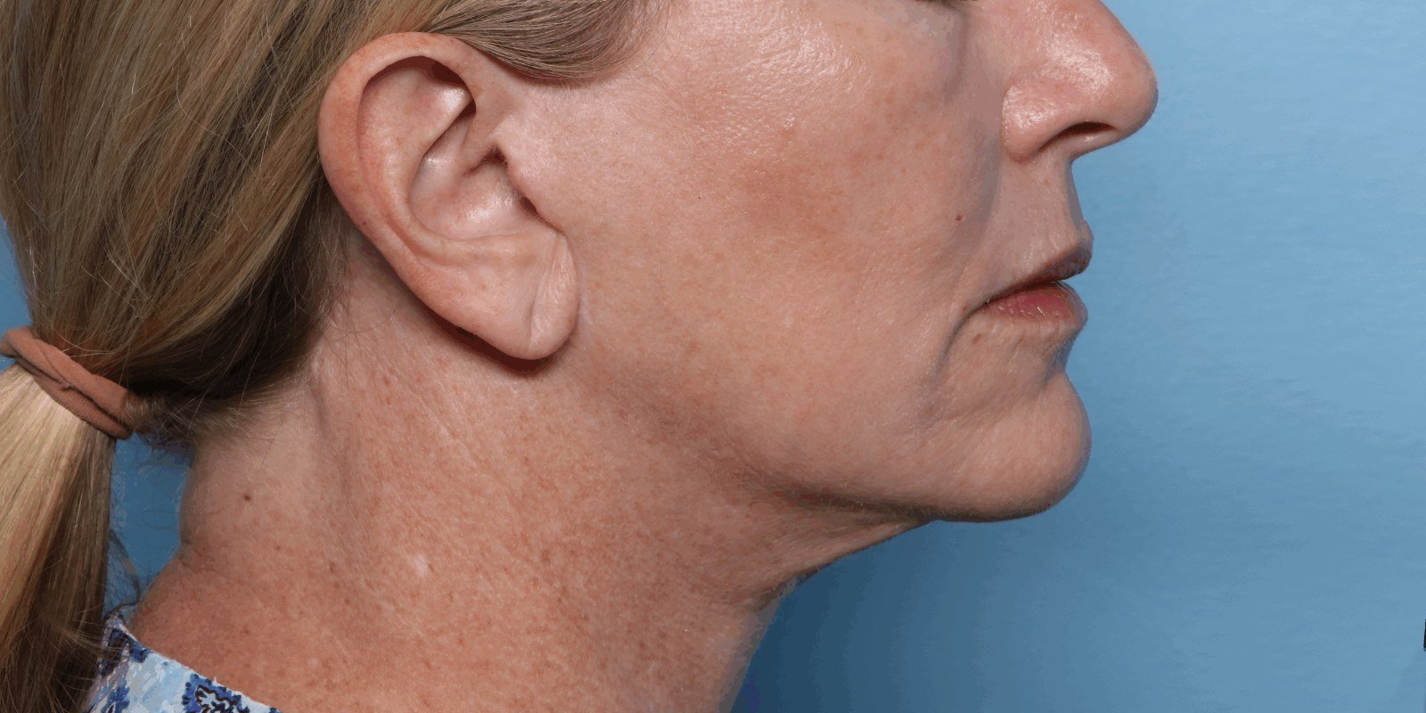 After XERF · Jawline, profile