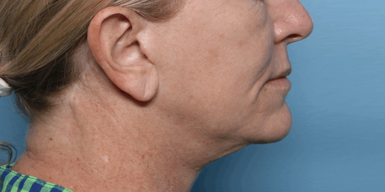 Before XERF · Jawline, profile